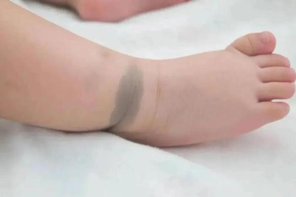 看胎记位置算命 看胎记位置算命