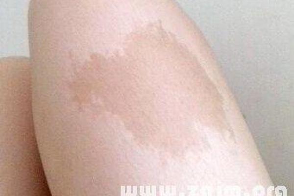 胳膊胎记可以算命吗- 胳膊胎记可以算命吗-