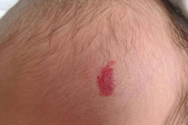 胳膊胎记可以算命吗- 胳膊胎记可以算命吗-