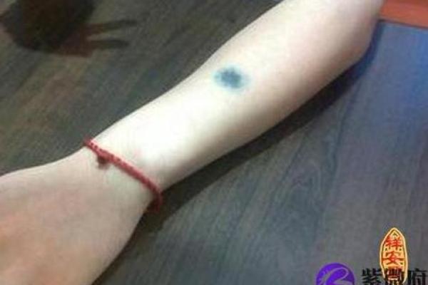 胎记的位置算命