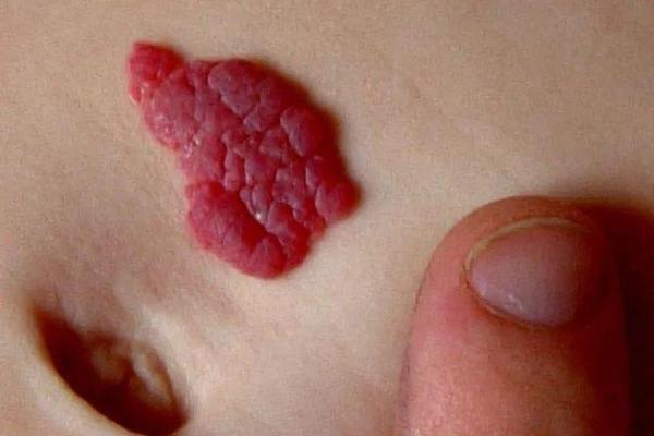 胎记的位置算命