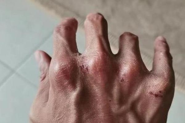 八字烫伤案例:交战必应灾 八字烫伤案例:交战必应灾