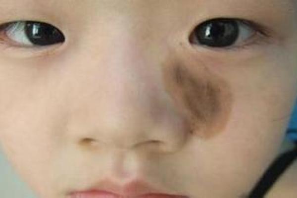 胎记算命全解