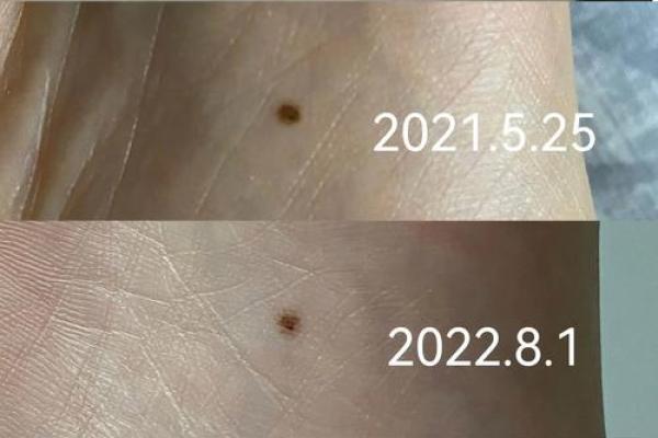 男人脚痣相算命图解