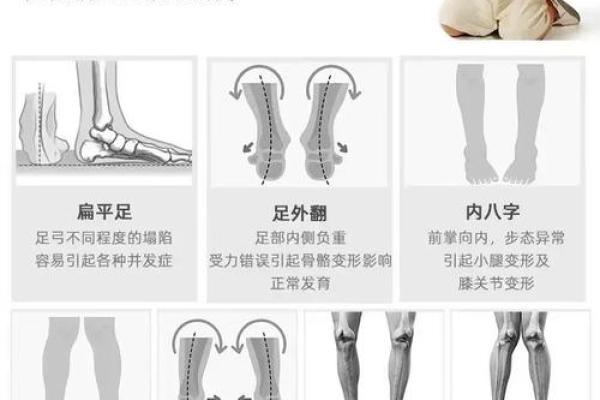 纠正外八字脚