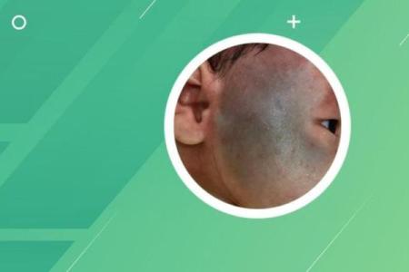 看脸上胎记算命知命运