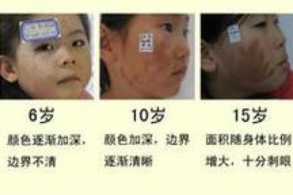 人体胎记算命的解释分析