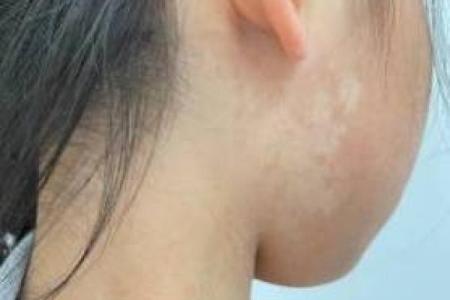 白色胎记算命分析