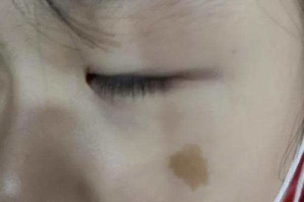 看脸上胎记如何算命