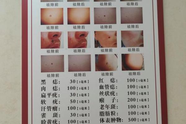 祛痣要算命吗