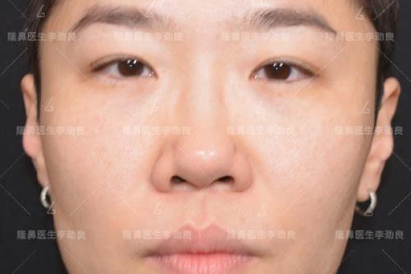 鼻子两侧八字纹图片