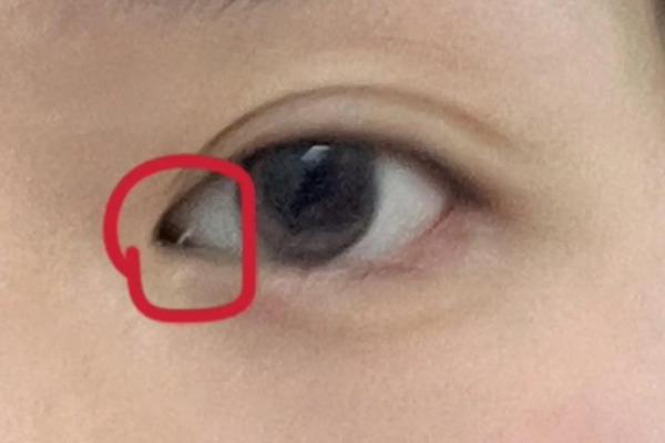 算命左眼白眼球有痣代