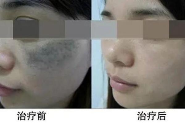 面部胎记算命