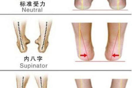 小孩走路内八字或者外八字有问题吗？该如何纠正？