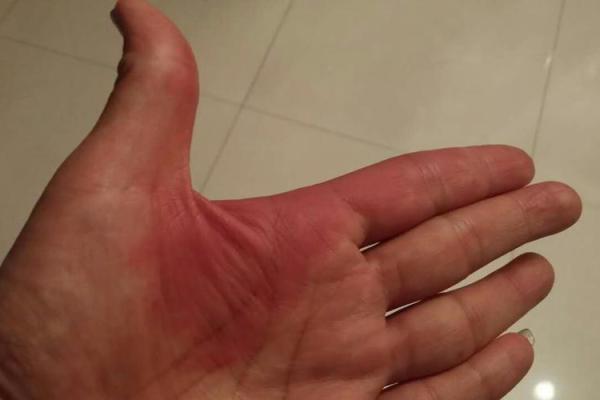 红色胎记算命看危害