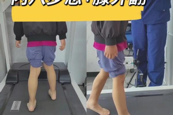 小腿内八字
