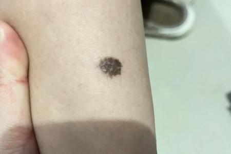 腿上有胎记算命分析
